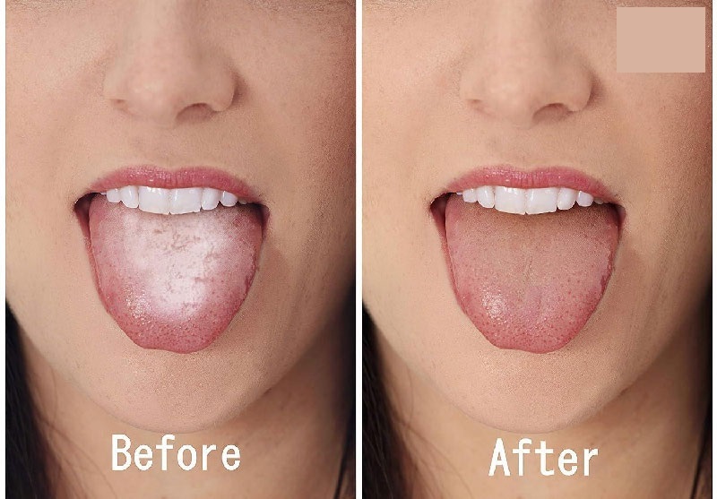 ترفندهای تمیز کردن زبان برای رهایی از بوی بد دهان (صبح من)