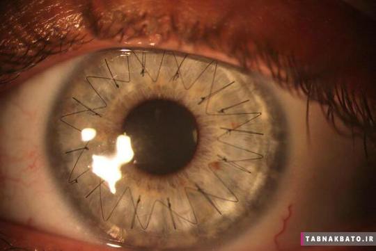 چشم انسان بعد از عمل کاشت قرنیه, نخ های جراحی نازک و ظریف روی آن به چشم می خورند