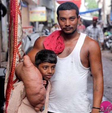 جوان هندی با دست 20 کیلوگرمی