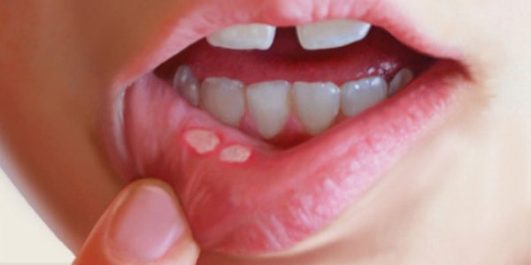 چگونه به بهبودی آفت دهان کمک کنیم؟