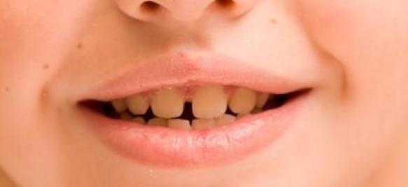 آیا قطره آهن در سیاهی دندان‌های کودک نقش دارند؟