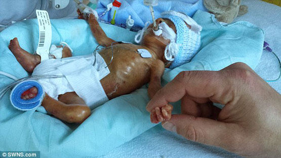 ماجرای نوزادی که 100 روز برای زندگی جنگید + تصاویر