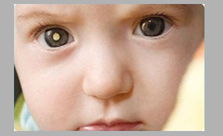علائم تومور چشمی کودکان چیست؟
