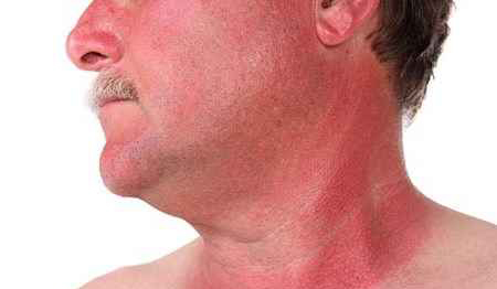 رفع آفتاب سوختگی با این درمان طبیعی