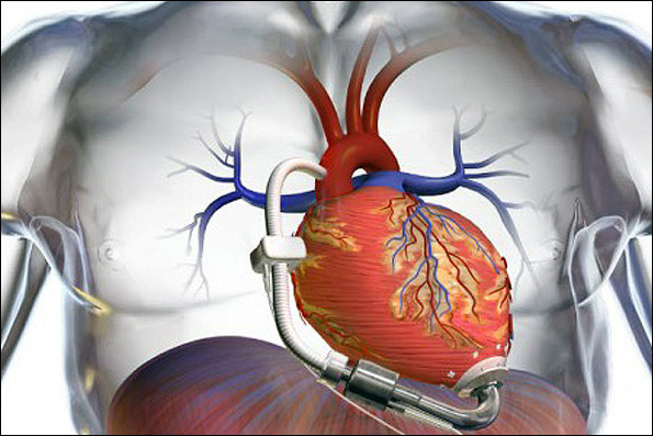 دانسته هایی از دریچه ‏های مصنوعی قلب