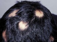 علل رایج ریزش موی سکه ای