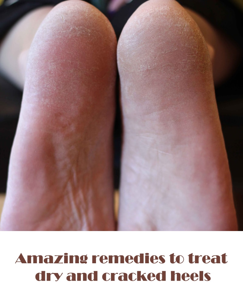 راهکارهای اصلی برای رفع خشکی پوست پا