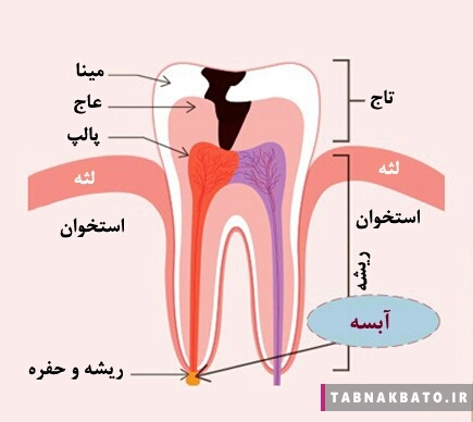 عفونت ریشه ی دندان و لثه چگونه درمان می شود؟