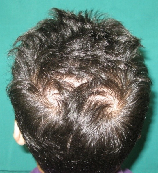 تاثیر ظاهر مو در نتیجه عمل پیوند مو