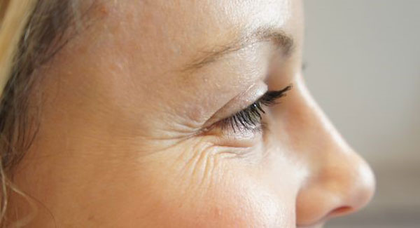 درمان چروک و خطوط پنجه کلاغی در اطراف چشم