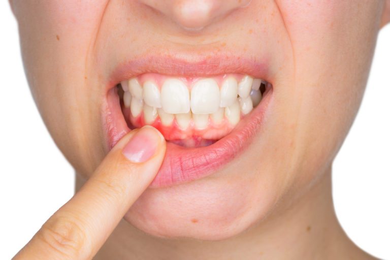 با روش های خانگی ساده عفونت دندانمان را از بین ببریم