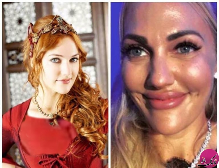 چهره ی جدید بازیگر معروف ترکیه ای پس از جراحی زیبایی صدای طرفدارانش را درآورد!