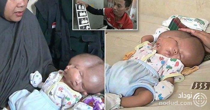تولد نوزادی با دو مغز همه را شوکه کرد +عکس