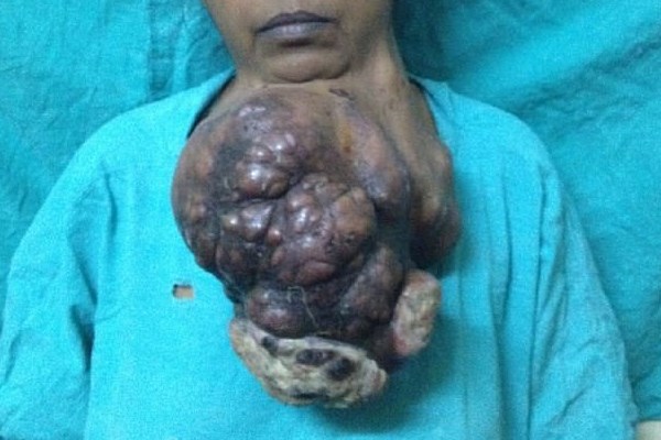 تومور ۵ کیلویی در چانه زن هندی +تصاویر