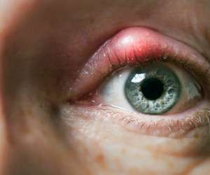 درمان “گل مژه” چشم با 23 روش معجزه آسای خانگی و طبیعی