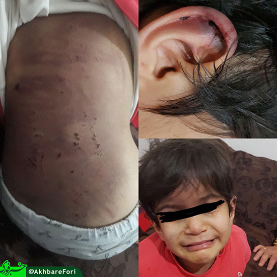 کودک‌آزارى وحشتناک توسط نامادری در ارومیه+عکس
