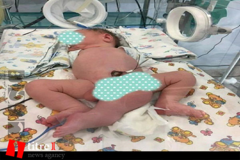تصاویری از تولد نوزاد ۳ پا در روسیه