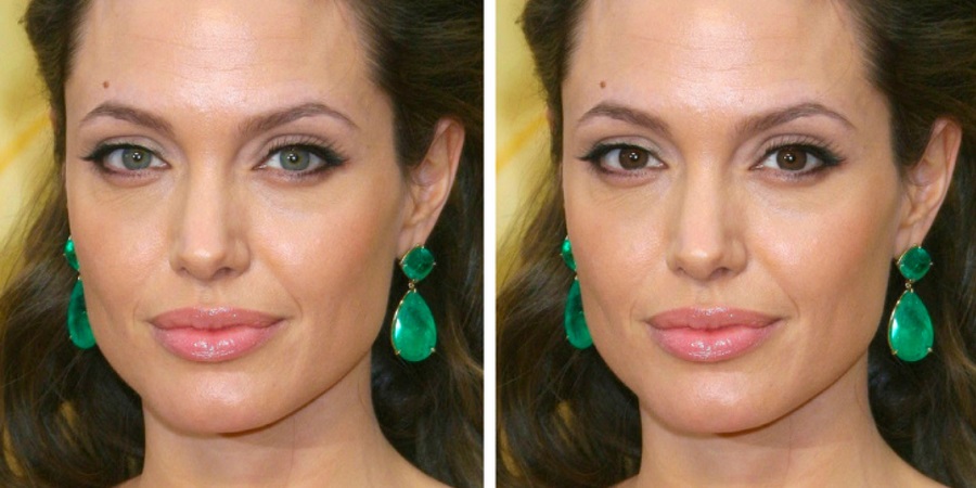 Из карих глаз в голубые операция до и после фото