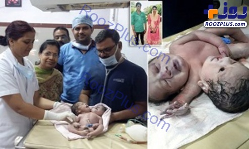 تولد نوزاد دو سر در هندوستان +عکس
