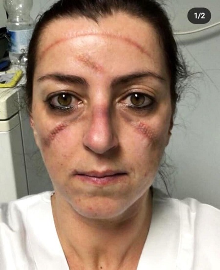 چهره‌های کبودِ کادر درمان در مقابله با کرونا +عکس