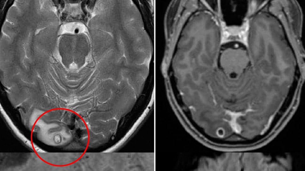 پیدا شدن تخم های کرم نواری در مغز زن استرالیایی پس از ۷ سال سردرد +عکس