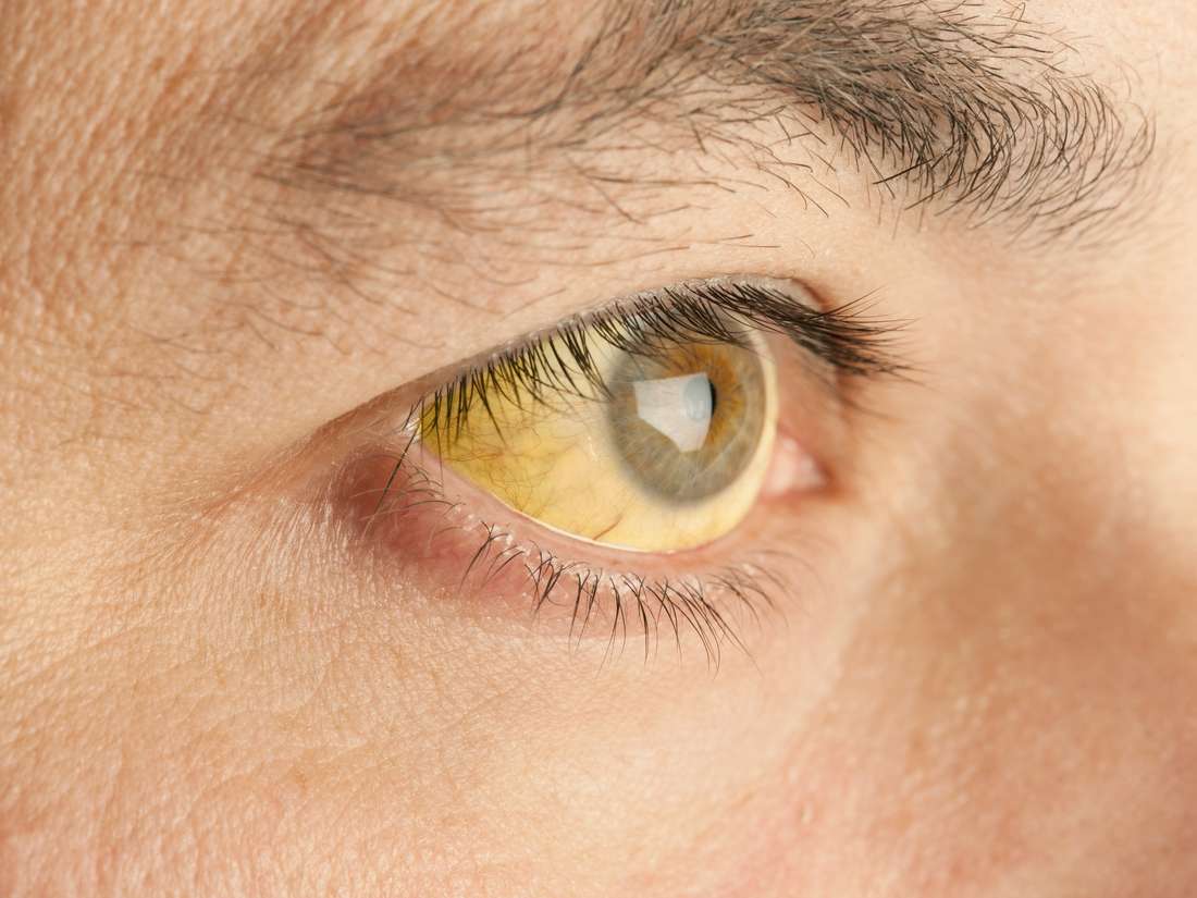 زردی چشم کی خطرناک می شود؟