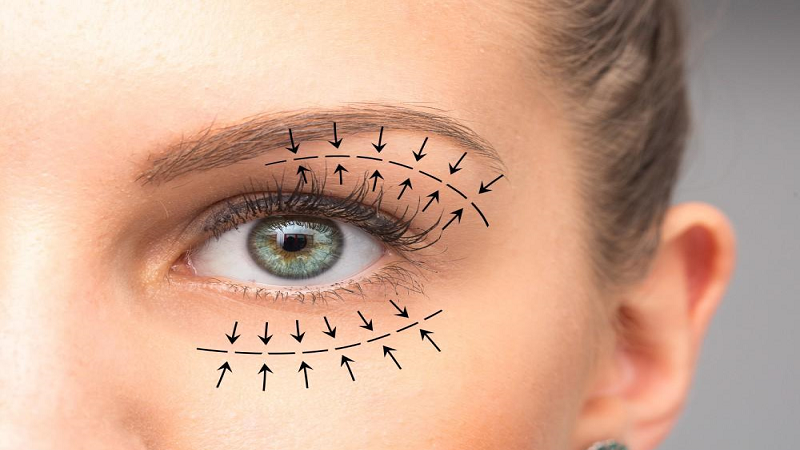 روشی برای برطرف کردن افتادگی پلک برای حفظ زیبایی چشم ها