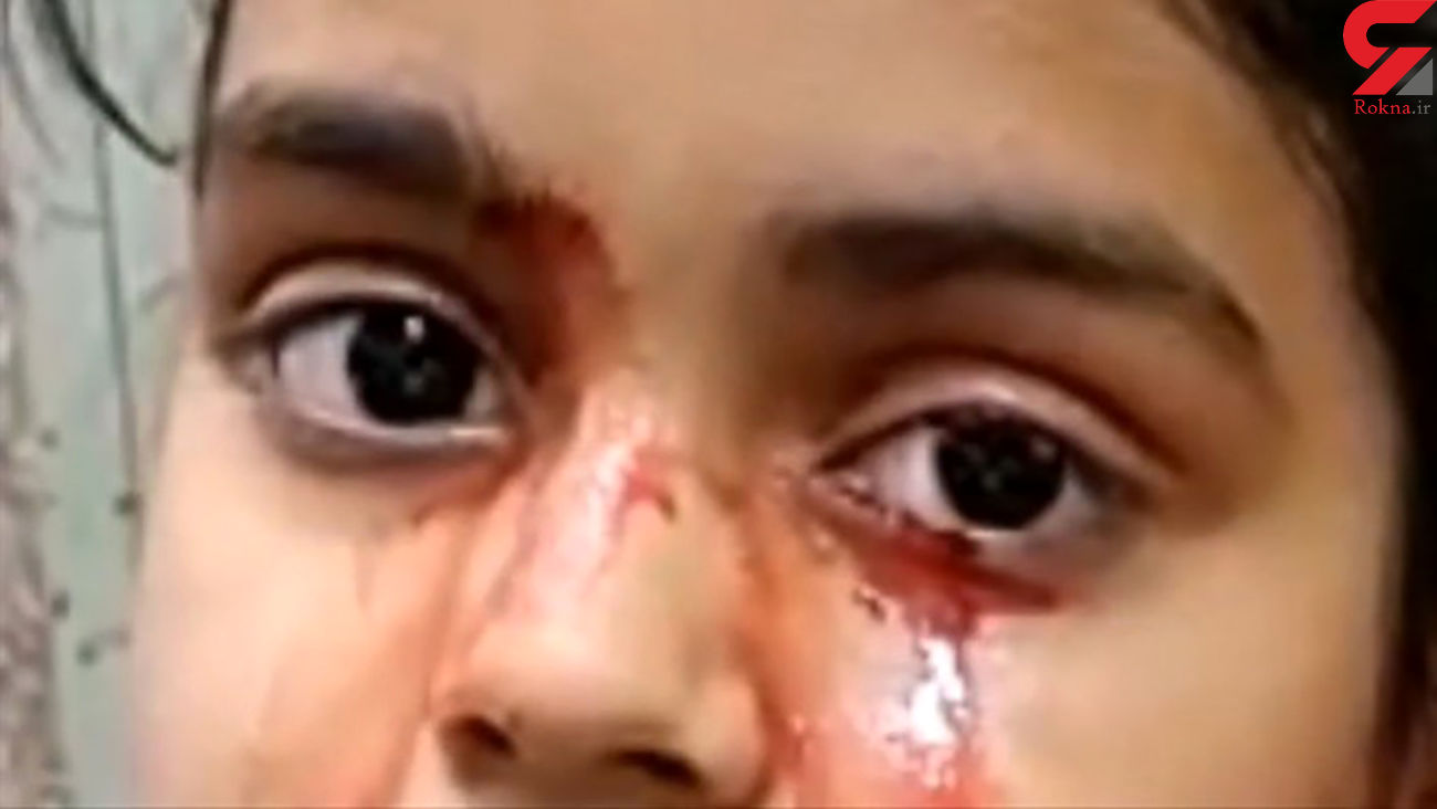 دختری ۱۱ ساله به جای اشک خون گریه می‌کند +عکس