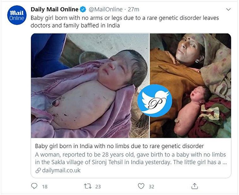 به دنیا آمدن نوزاد بی دست و پا در هند+عکس