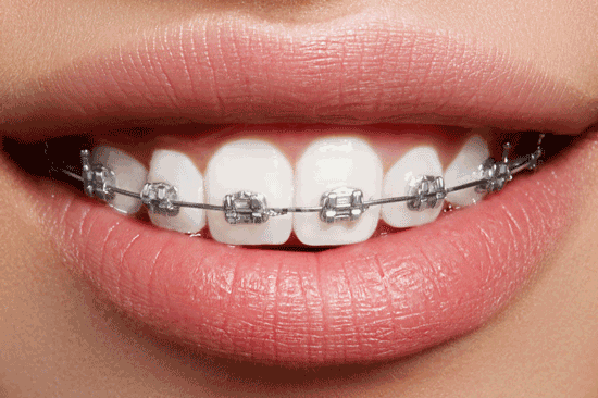 بستن فاصله میان دندان‌ها؛ بهترین روش کدام است؟