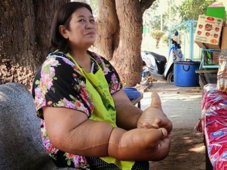بیماری نادر زنی که بزرگترین دست‌های جهان را دارد+عکس