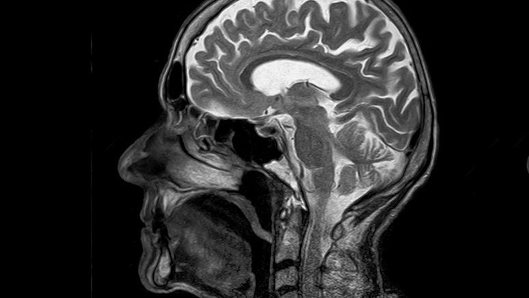 بر اساس پژوهش‌های تازه، تنها یک ژن منفرد باعث شده که مغز انسان‌ها اینقدر بزرگ باشد!