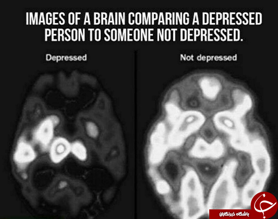 شکل مغز یک انسان افسرده +عکس