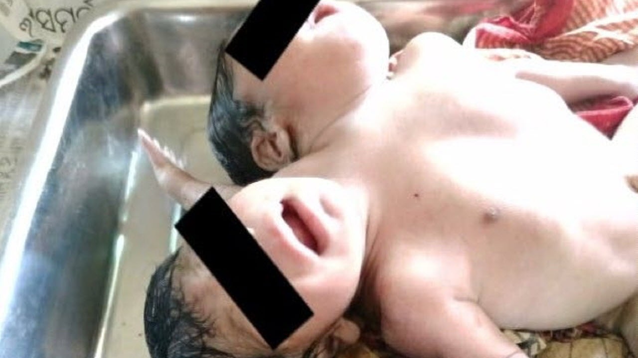 تولد یک نوزاد نادر با دو سر و سه دست+عکس
