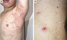 مولوسکوم کونتاژیوزوم چه نوع عفونت پوستی است؟