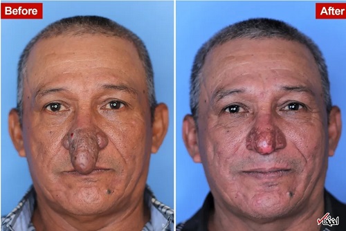 جراحی خیره‌کننده‌ی بینی یک مرد ۵۷ ساله
