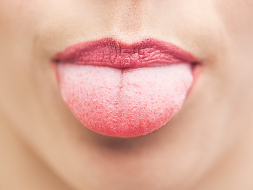 پیوند زبان جدید از ران بیمار مبتلا به سرطان زبان