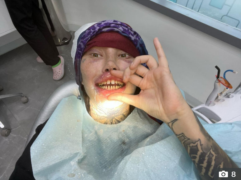 نگرانی طرفداران سلبریتی تیک تاکی از اعتیادش به جراحی زیبایی
