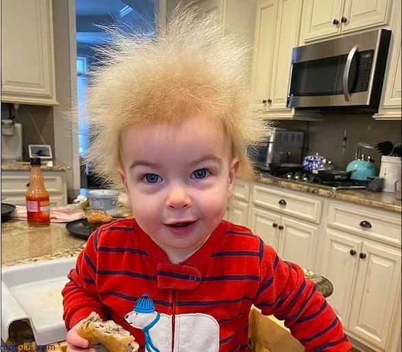 موهای عجیب یک کودک به دلیل بیماری نادر
