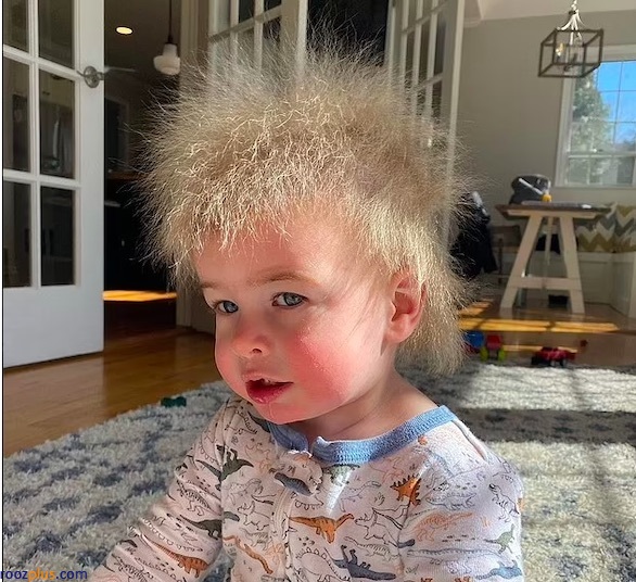 موهای عجیب یک کودک به دلیل بیماری نادر