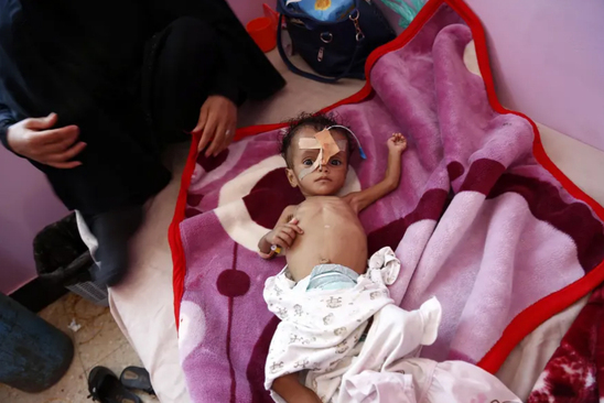 نوزاد یمنی در آستانه مرگ