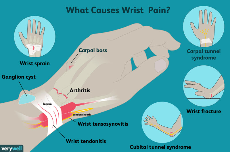 درد مچ دست چه علت‌هایی دارد و چطور درمان می‌شود؟