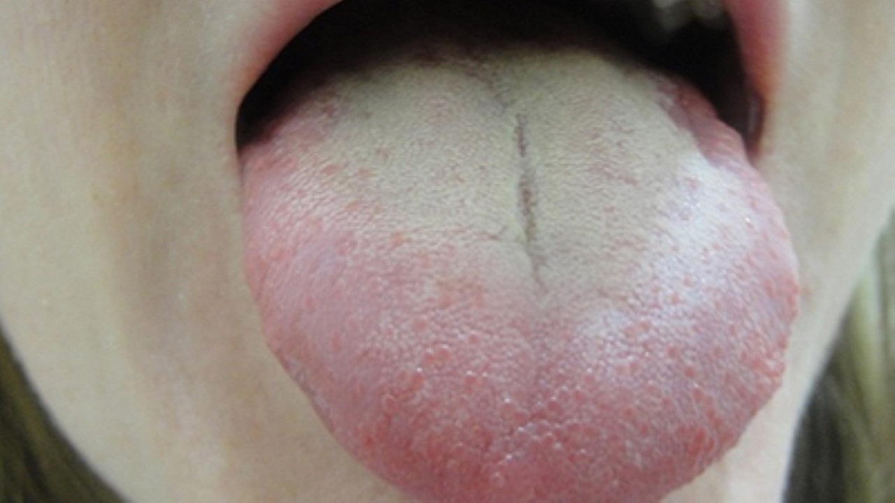 سفید شدن زبان زنگ خطر کدام بیماری است؟