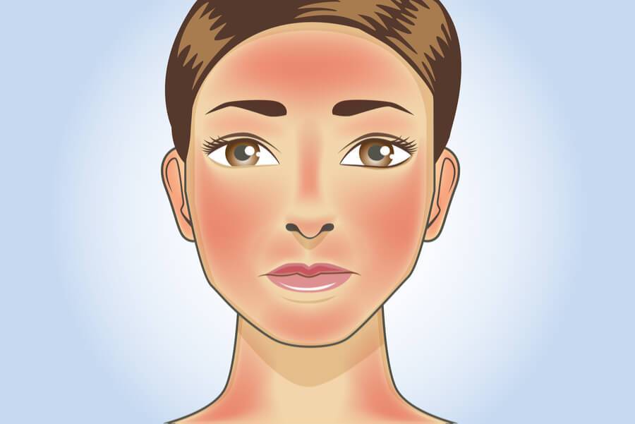 درمان قرمزی پوست صورت