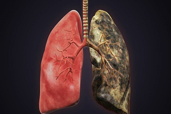 سرطان ریه فقط مخصوص سیگاری‌ها نیست