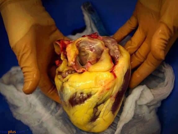 تصویری تکان دهنده از قلب فرد چاقی که با سکته فوت کرد