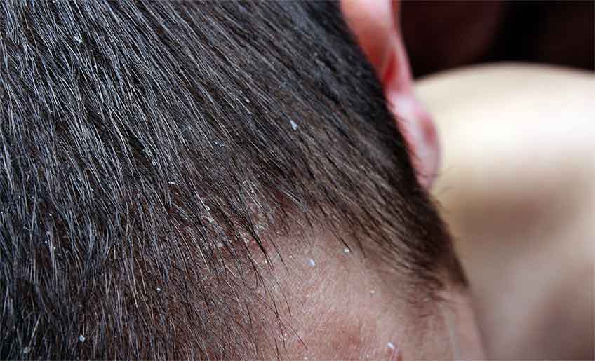 علت خشکی پوست سر چیست و چگونه آن را درمان کنیم؟ (روزیاتو)