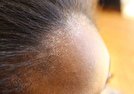 علت خشکی پوست سر چیست و درمان آن کدام است؟