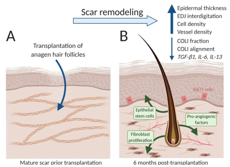 یک مطالعه جدید نشان می‌دهد که پیوند فولیکول مو می‌تواند جای زخم را از بین ببرد(یک پزشک)
