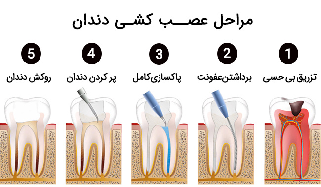 عصب کشی دندان چگونه انجام می‌شود؟ آیا درد بعد از عصب کشی طبیعی است؟(روزیاتو)